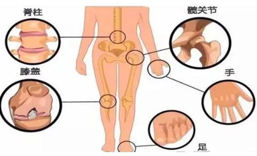 巖藻多糖復(fù)配綠殼貽貝防治糖尿病性骨關(guān)節(jié)炎