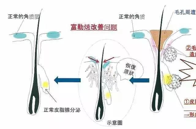 富勒烯改善膠原蛋白