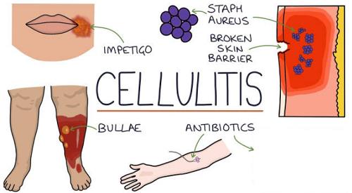 Skin and Soft Tissue Infections.png